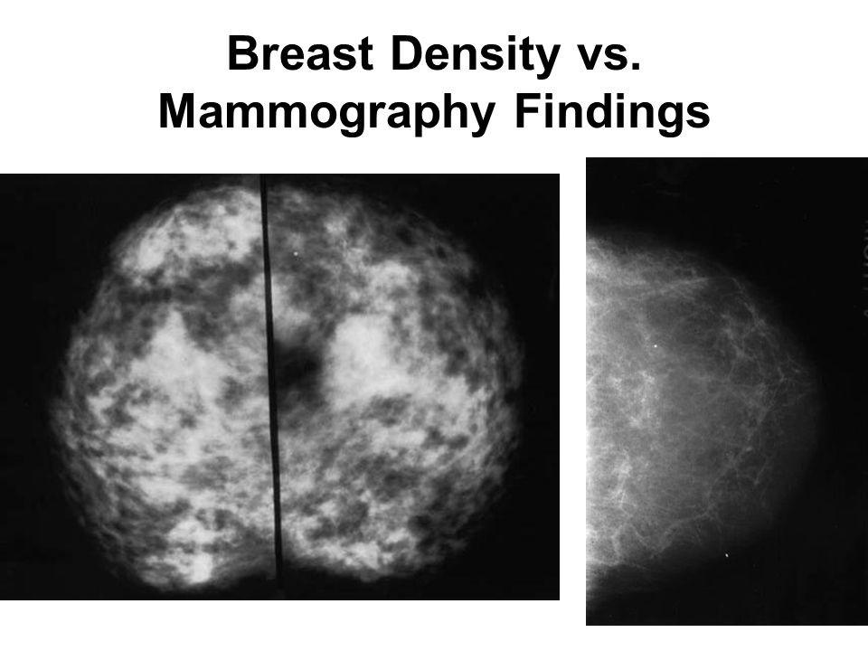 asymetrical small white Breast lesion findings